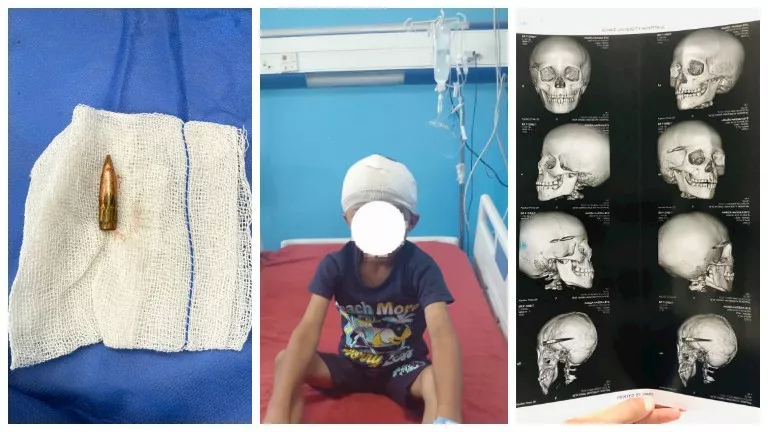تفاصيل استخراج رصاصة من مخ طفل بمستشفى جامعة سوهاج -صدى الخبر