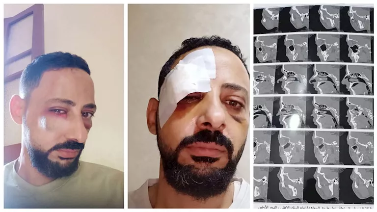 استغاثة مواطن بالغربية بعد إصابته بكسور: “ركبت شرايح ومسامير” -صدى الخبر استغاثة مواطن بالغربية بعد إصابته بكسور: "ركبت شرايح ومسامير" -صدى الخبر